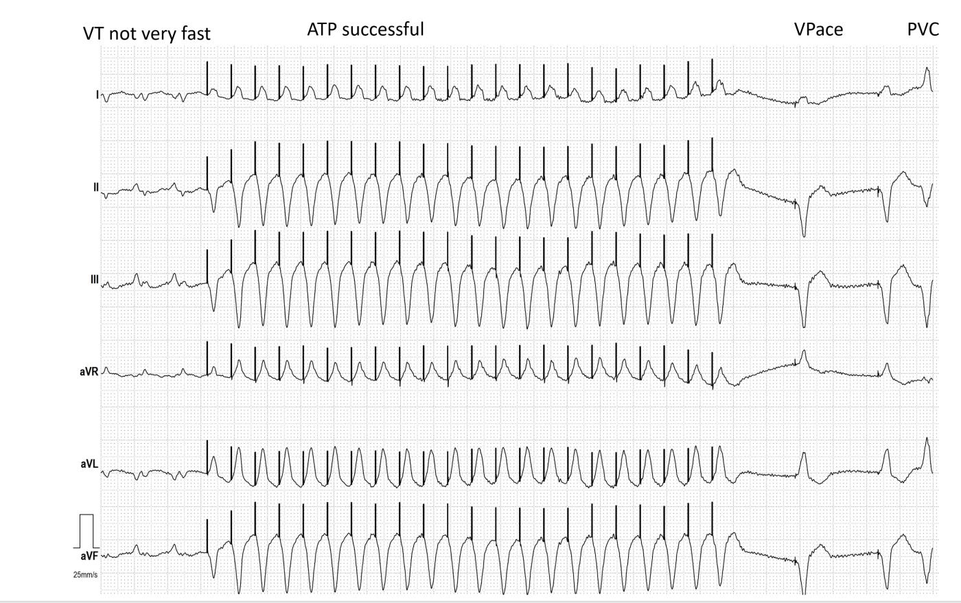 VENTRICULAR TACHYCARDIA WITH SUCCESSFUL ATP ECG Guru Instructor